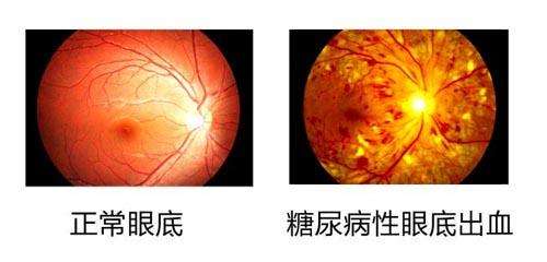 视网膜病变眼底